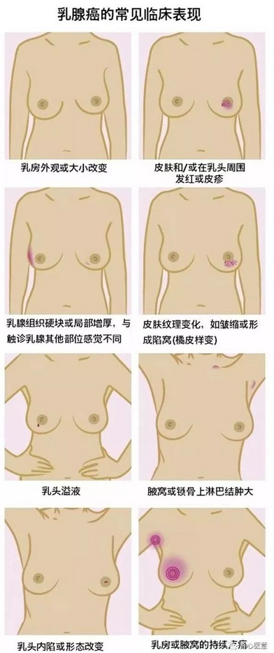 乳腺癌發(fā)生轉(zhuǎn)移了，手術(shù)還有意義嗎？